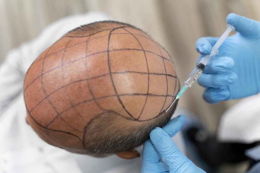hair transplant consultation
