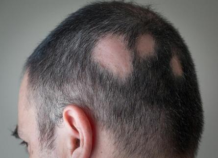 excessive hair loss