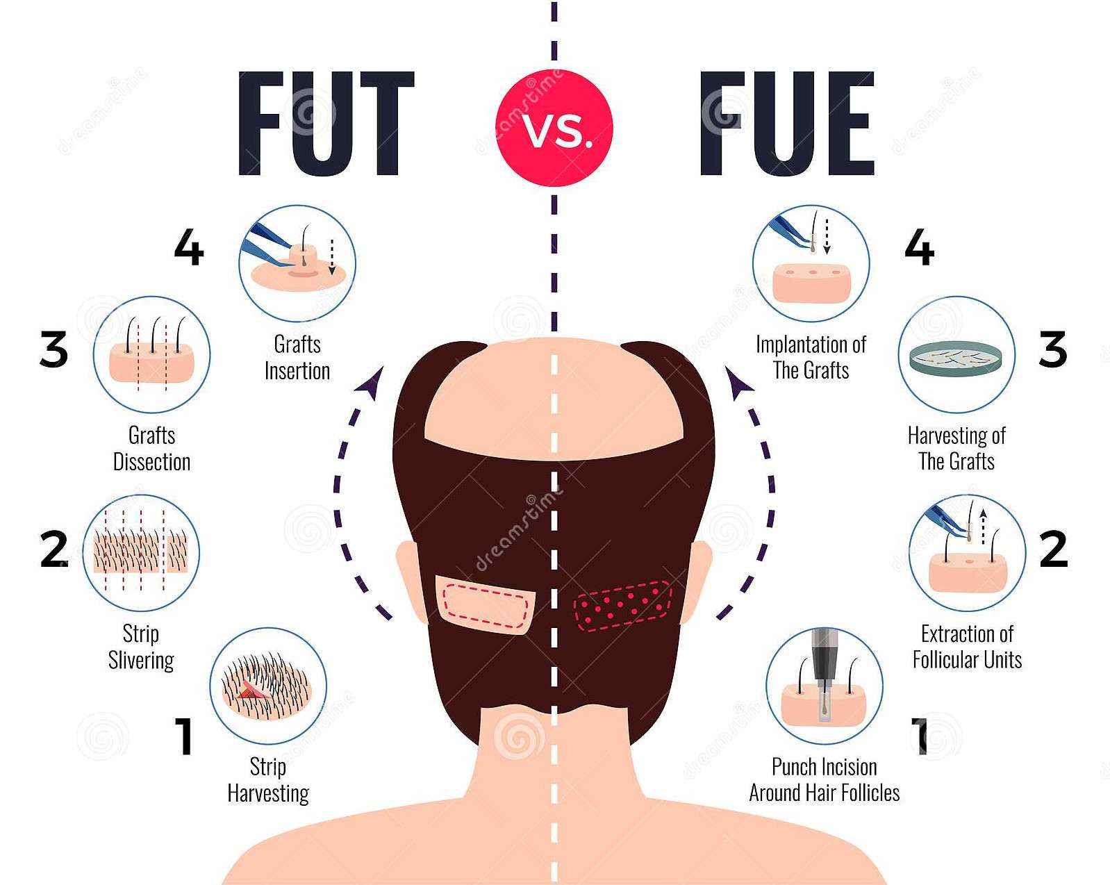 hair transplant surgery